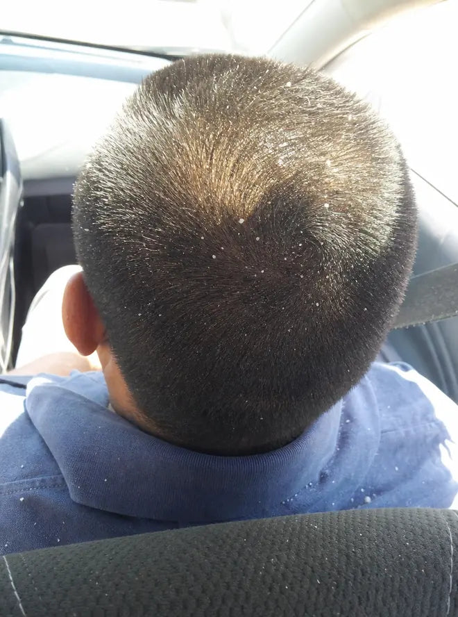 Antes