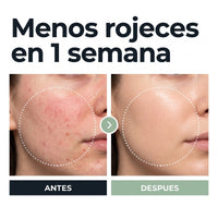 Menos rojeces en 1 semana