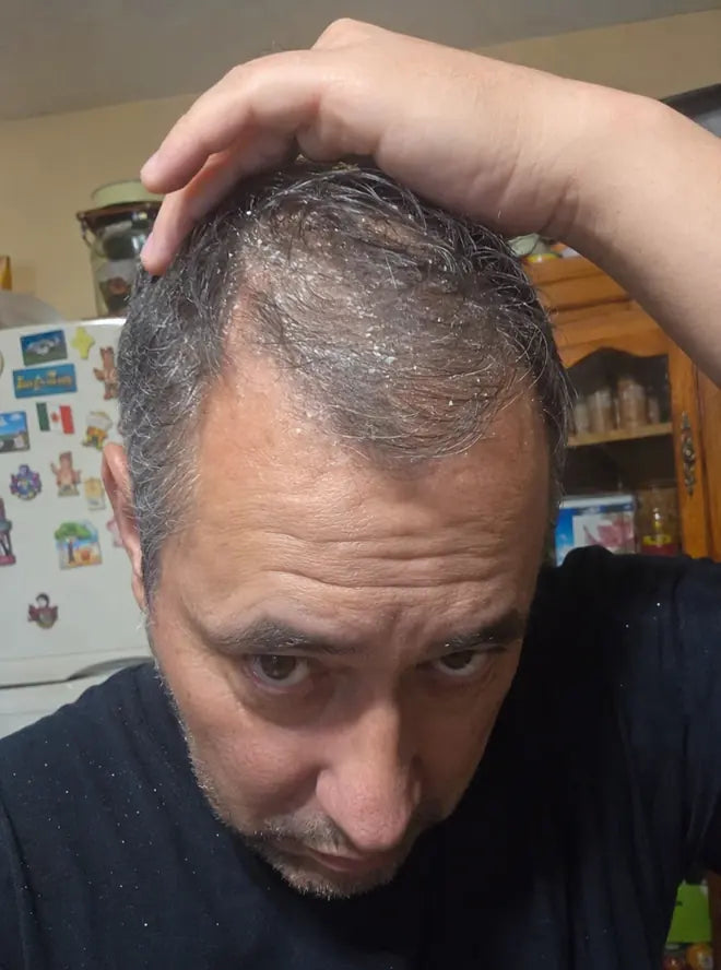 Hombre mostrando el cuero cabelludo con escamas